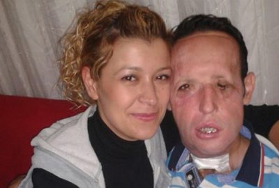 Yüz nakli olan Sert evleniyor