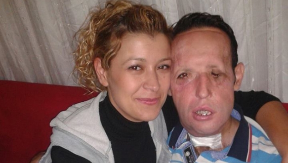 Yüz nakli olan Sert evleniyor