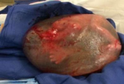 Mucize bebek böyle doğdu