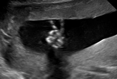 Anne karnında büyük şok!