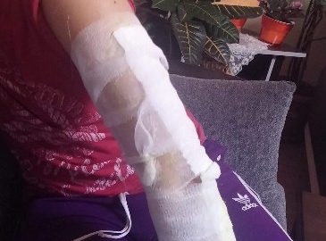 Balıkesir’in Edremit ilçesinde hıdrellez ateşine düşen gencin kolu yandı. Olay