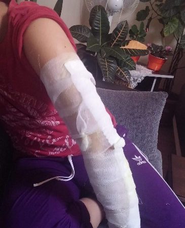 Balıkesir’in Edremit ilçesinde hıdrellez ateşine düşen gencin kolu yandı. Olay