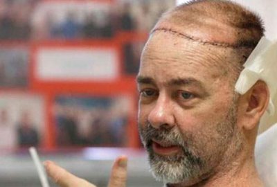 Dünyanın ilk kafatası nakli yapıldı