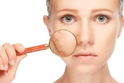 Cilt lekeleri kabusunuz olmasın