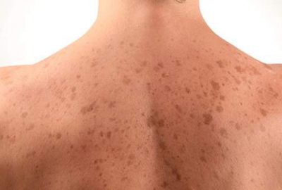 Sırtınızda böyle lekeler varsa dikkat