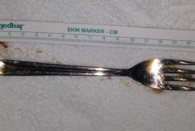 Midesinden çatal çıktı