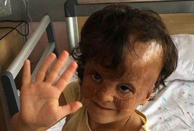 Esed rejimine bağlı birliklerin varil bombalı saldırısında yüzü yanan, bir