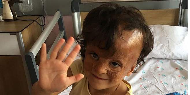 Suriyeli Fatma’nın ‘yüzü’ gülecek Esed rejimine bağlı birliklerin varil bombalı saldırısında yüzü yanan, bir