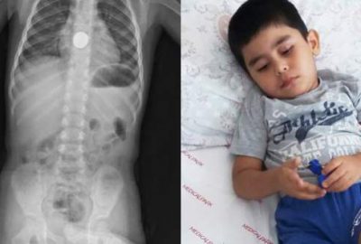 Yuttuğu pil yemek borusunu yaktı