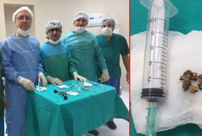 Bursa’da hastanın idrar kanalından 2 santimetrelik taş çıktı