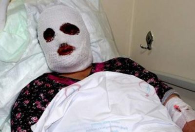 Temizlik yaparken yüzü yandı