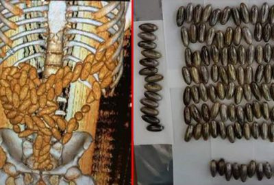 Midesinden çıkanlar şoke etti