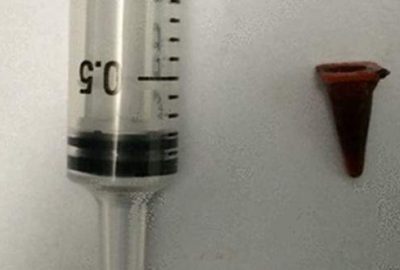 Çocukken ciğerine kaçan oyuncak 40 yıl sonra çıktı