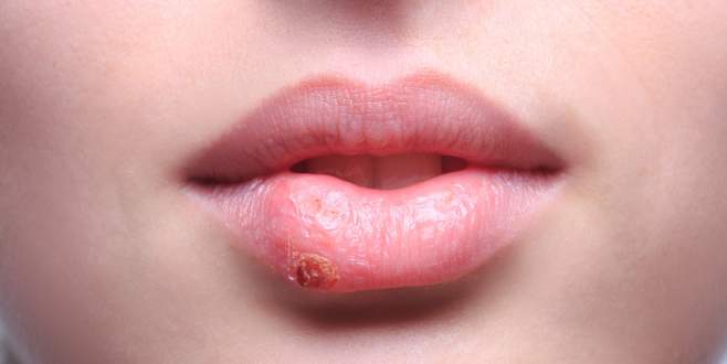 Uçuğa ne iyi gelir?