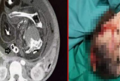 Midesi bulanıyordu! Karnından ikiz kardeşi çıktı…