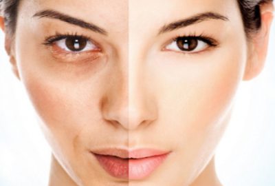 Gözaltı morluklarından kurtulmanın kolay yolları