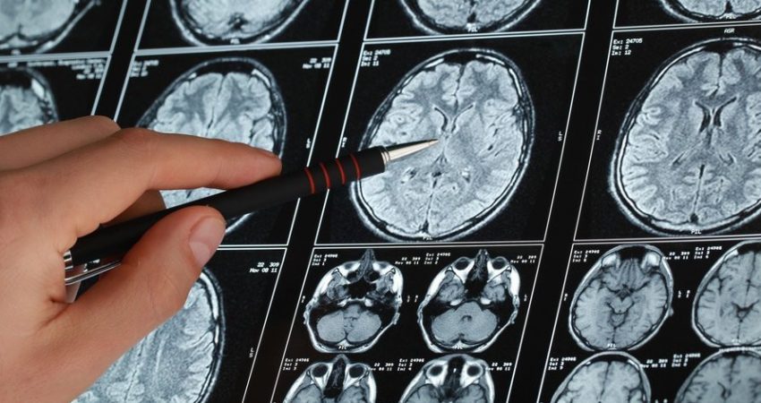 Prof. Dr. İbrahim Öztura, Türkiye’de 750 bin epilepsi hastası bulunduğunu,