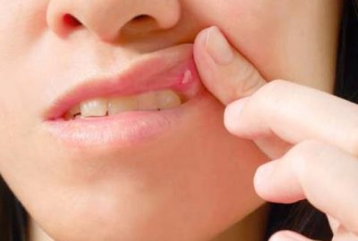 Aft yaralarını 1 saat içerisinde geçiren yöntem!