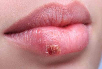 Uçuğu anında geçirecek 3 yöntem