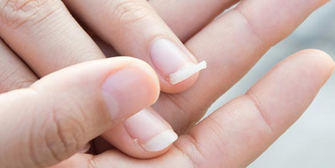 Tırnaklarınız sürekli kırılıyorsa nedeni bu hastalık olabilir!