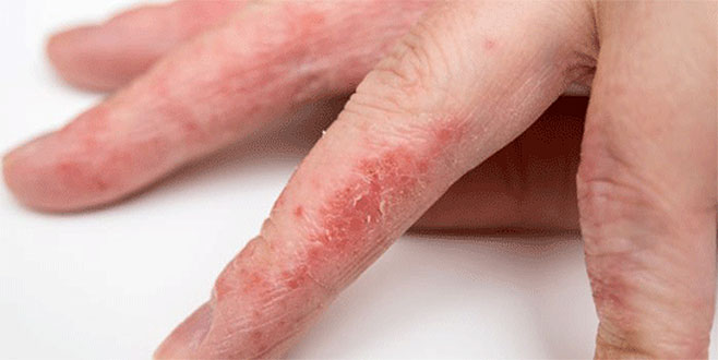 Ev kadınlarının korkulu rüyası: El egzaması