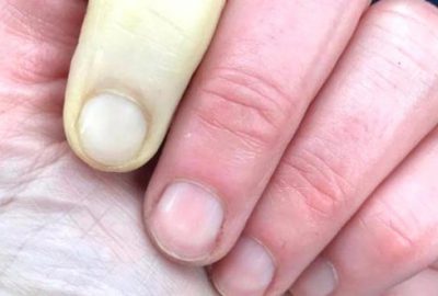 Güzel sunucunun parmağı bu hale geldi!