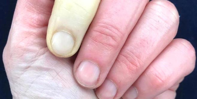 Güzel sunucunun parmağı bu hale geldi!