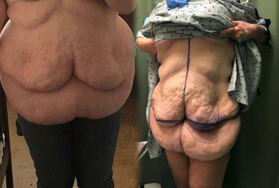 ‘Ameliyattan sonra bu hale geldim, fazladan bir çift göğsüm var’