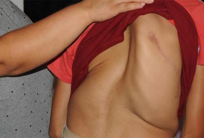 En çok kız çocuklarında görülüyor! Bu belirtilere dikkat!