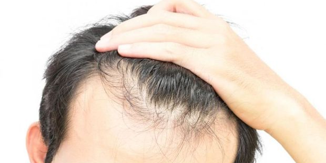 Sağlık Bakanlığı saç ekimi konusunda vatandaşları uyardı