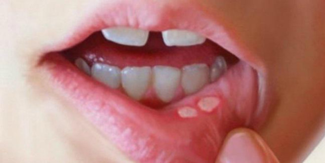 Aft yaralarını 1 saat içerisinde geçiren yöntem