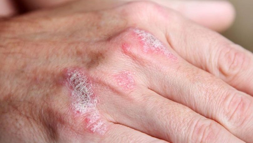 Sedef hastalığı nasıl geçer?