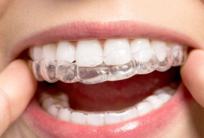 ‘Görünmeyen diş teli tedavide yeterli sonucu vermiyor’