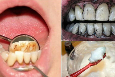 Diş taşlarını ortadan kaldırmak için 3 etkili yöntem
