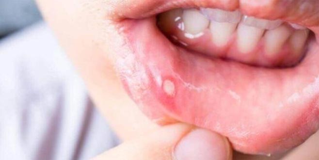 Aftları iyileştiren 5 ev yapımı çözüm