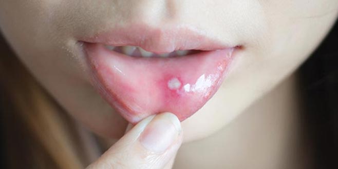 Aftları sadece 1 saat içerisinde iyileştiren ev yapımı tarif