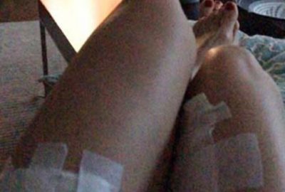 Ünlü mankenin bacakları yandı!