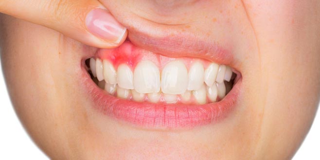 Diş eti çekilmesine ne iyi gelir?