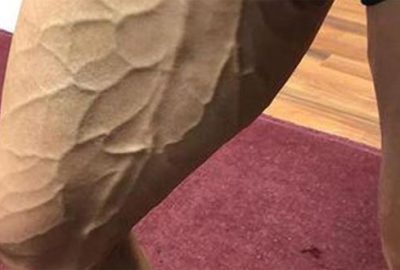 Bursasporlu futbolcunun bacağını görenler şok oldu!