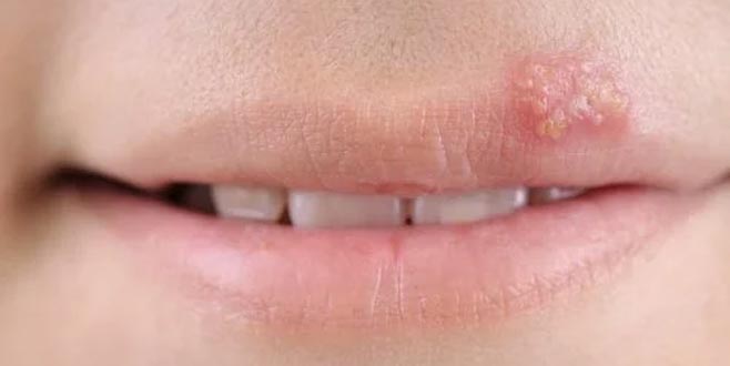 Uçuklarla başınız dertteyse dikkat!