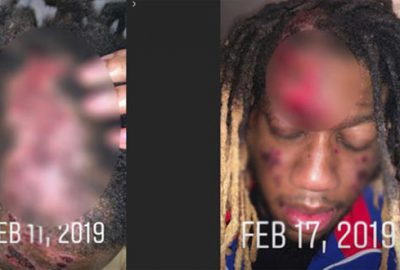 Ünlü rapçi et yiyen bakteri kaptı! Yüzünü yemeye başladı