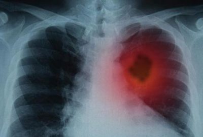 Akciğer embolisi nedir? Akciğer embolisi tedavisi…