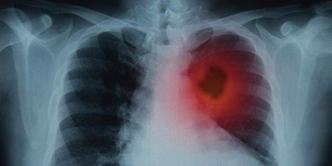 Akciğer embolisi nedir? Akciğer embolisi tedavisi…