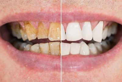 Diş taşlarından kurtulmanızı sağlayan 3 farklı yöntem