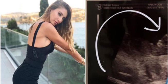 Şeyma Subaşı’nın ultrason fotoğrafı sosyal medyada gündem oldu