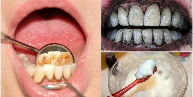 Diş taşlarını ortadan kaldırmak için 3 etkili yöntem