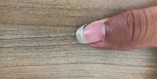 Beyaz lekeler, koyu çizgiler… Önemsenmiyor ama tırnaklar sağlığınız hakkında pek çok şey söylüyor
