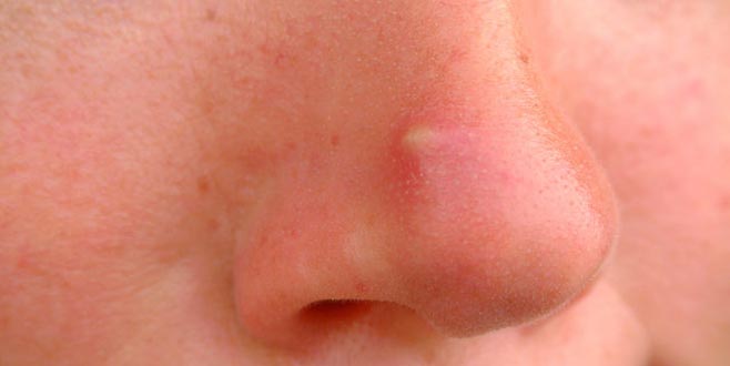 ‘Ölüm üçgeni’, felce hatta ölüme bile yol açabiliyor