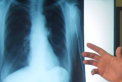 İmmüno-onkoloji ile akciğer kanseri tedavisi