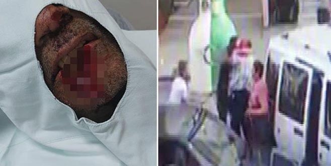 Kayınpederinin dudağını ısırarak parçalamıştı! ‘Hannibal damat’ konuştu Kayınpederinin dudağını ısırarak parçalamıştı! ‘Hannibal damat’ konuştu